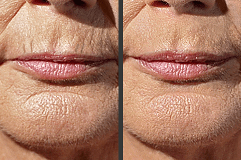 How Can Pressure Remove Wrinkles?