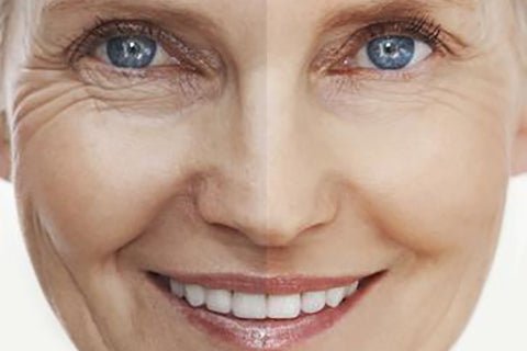 What Causes Laugh Lines?