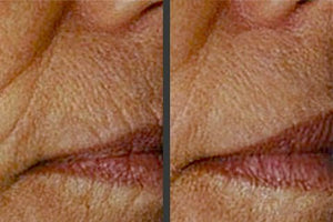 How to Maintain Your AngelLift Dermastrips Line Lifting Results