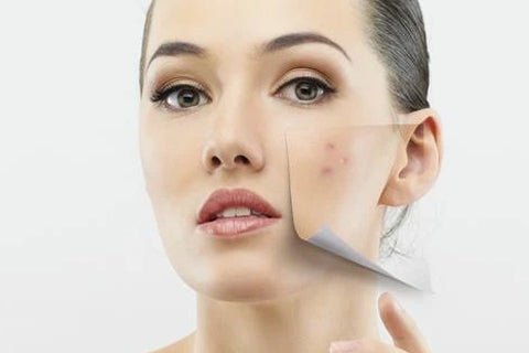 Adult Acne: How to Prevent It