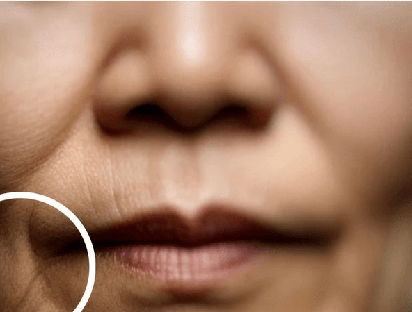 Lower-face aging and marionette lines