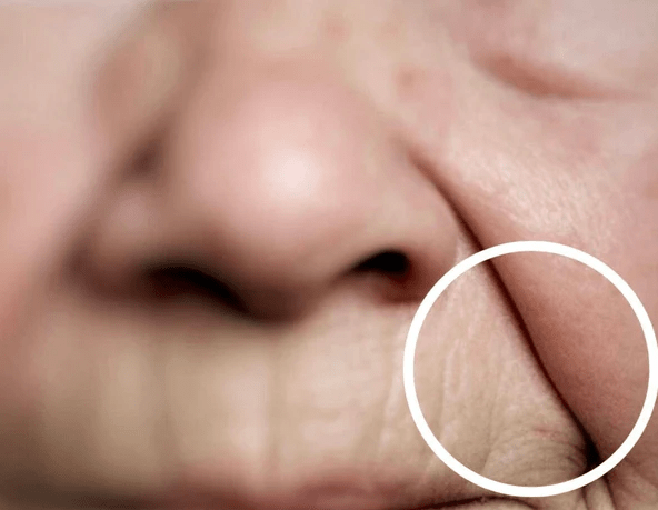 Lower-face volume loss and nasolabial folds