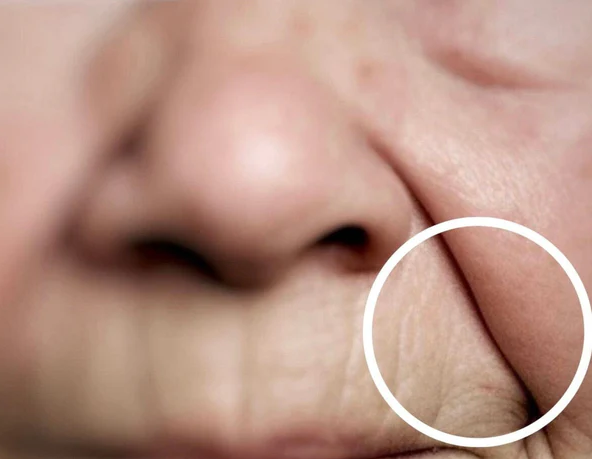 A natural lower-face lift