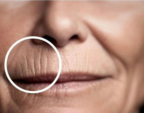 Fine lines around the mouth