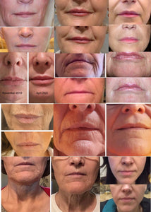 AngelLift® Professional DermaStrips
