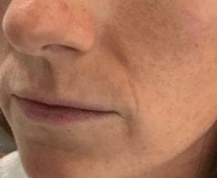 Nasolabial lines, day 1