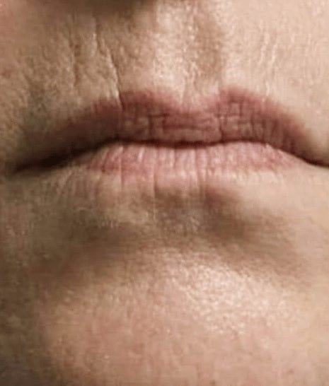 Lip enhancement, day 1