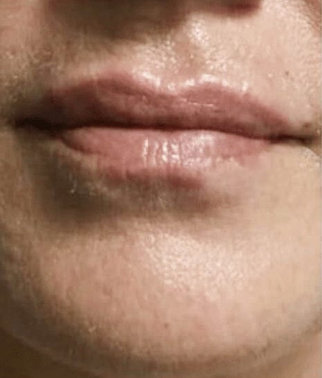 Lip enhancement, day 30