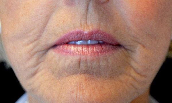 Lip enhancement, day 1