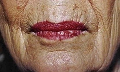 Lip enhancement, day 1