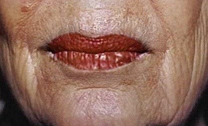 Lip enhancement, day 30
