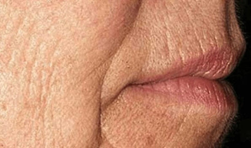 Peri-oral lines, day 1