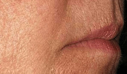 Peri-oral lines, day 30