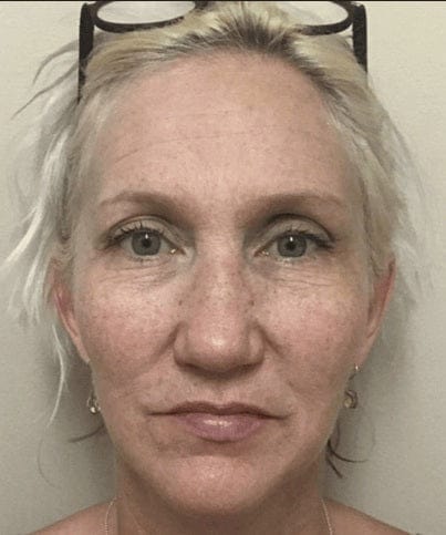Peri-oral lines, day 30