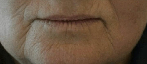 Nasolabial lines, day 1