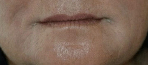 Nasolabial lines, day 30