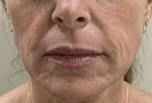 Peri-oral lines, day 1