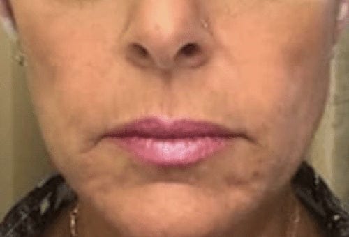 Peri-oral lines, day 30