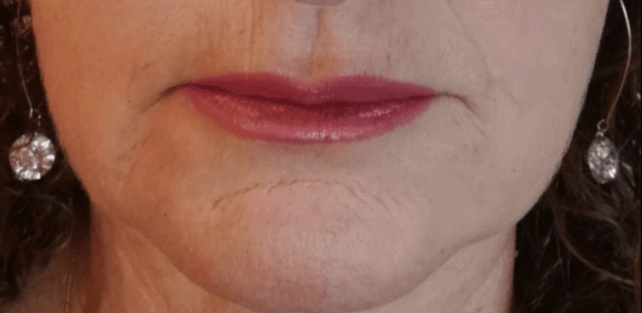 Customer photograph, marionette lines, day 30