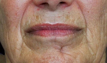 Nasolabial lines, day 1
