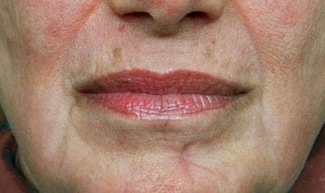 Nasolabial lines, day 30