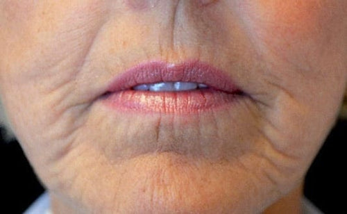 Lip enhancement, day 1
