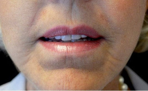 Lip enhancement, day 30