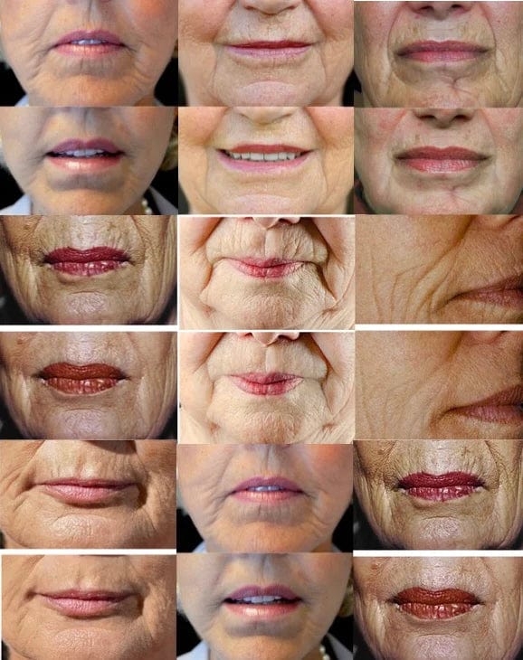 AngelLift® Professional DermaStrips