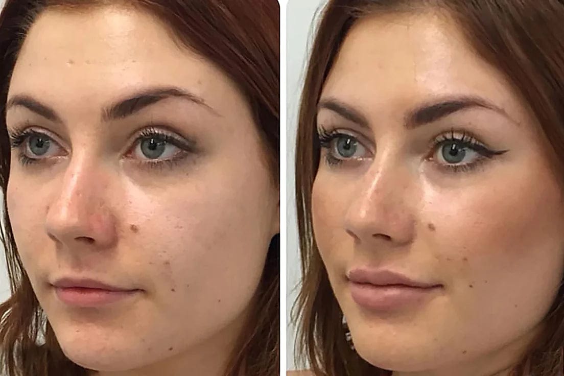 AngelLift® Vermilion DermaStrips